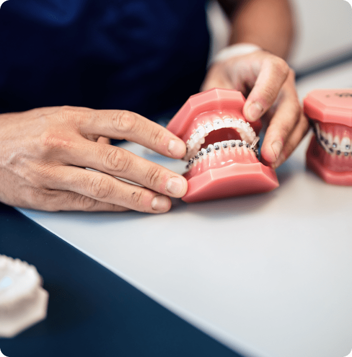 Appareillage dentaire : les bagues métalliques et céramiques
